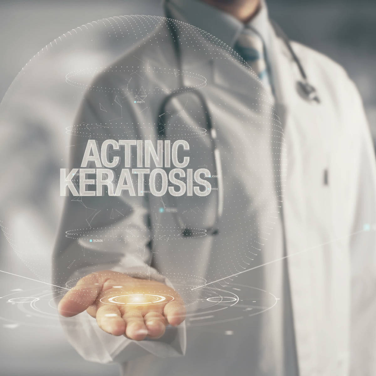 Doctor holding in hand Actinic Keratosis