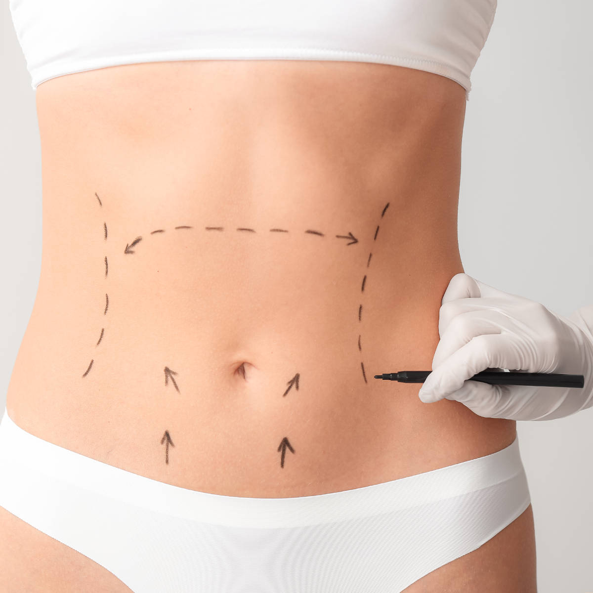 Plastic surgeon applying marks on female body