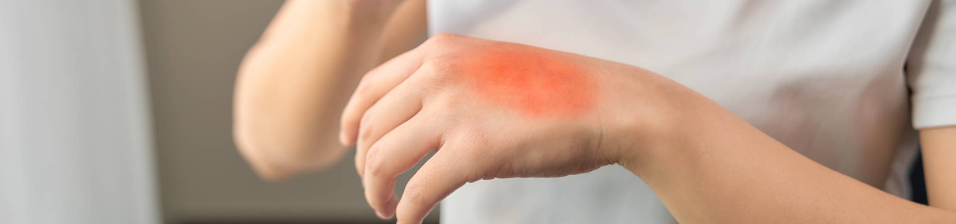 Woman hand has red skin rash itch